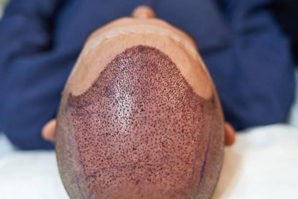 Detail of scalp of male lying down after hair transplant surgery Detail of scalp of male lying down after hair transplant surgery hair transplant stock pictures, royalty-free photos & images